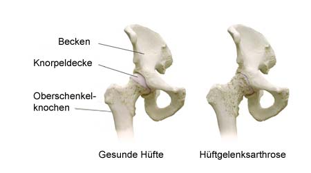 skizze Hüftgelenksarthrose