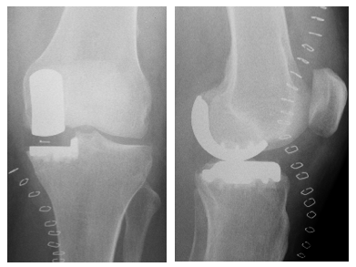 AG Endoprothetik Darstellung Knie