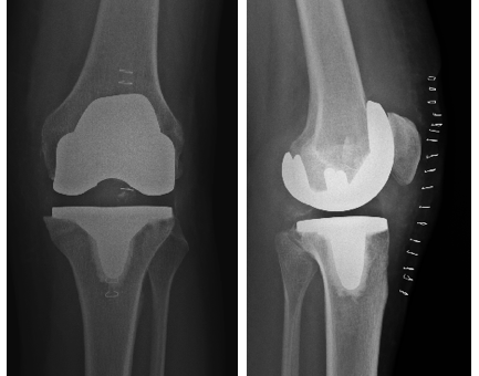 AG Endoprothetik Darstellung Knie